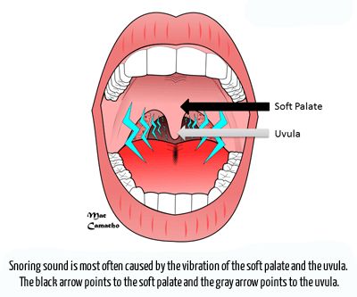 Resiko kesehatan terkait&nbsp;dengkur